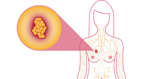 mamografiniai tyrimai